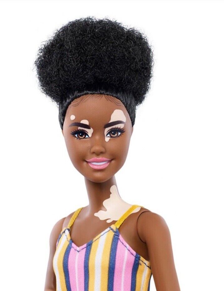 vitiligolu barbie 1